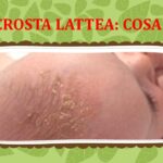 crosta testa neonato